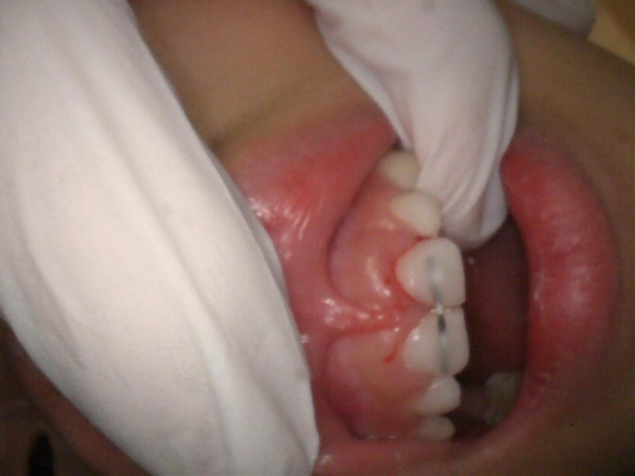前歯の外傷処置